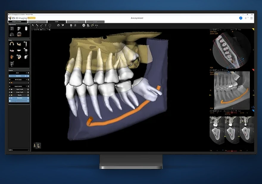 Segmentação dentária automática em software CBCT 3D — diagnóstico e planeamento digital