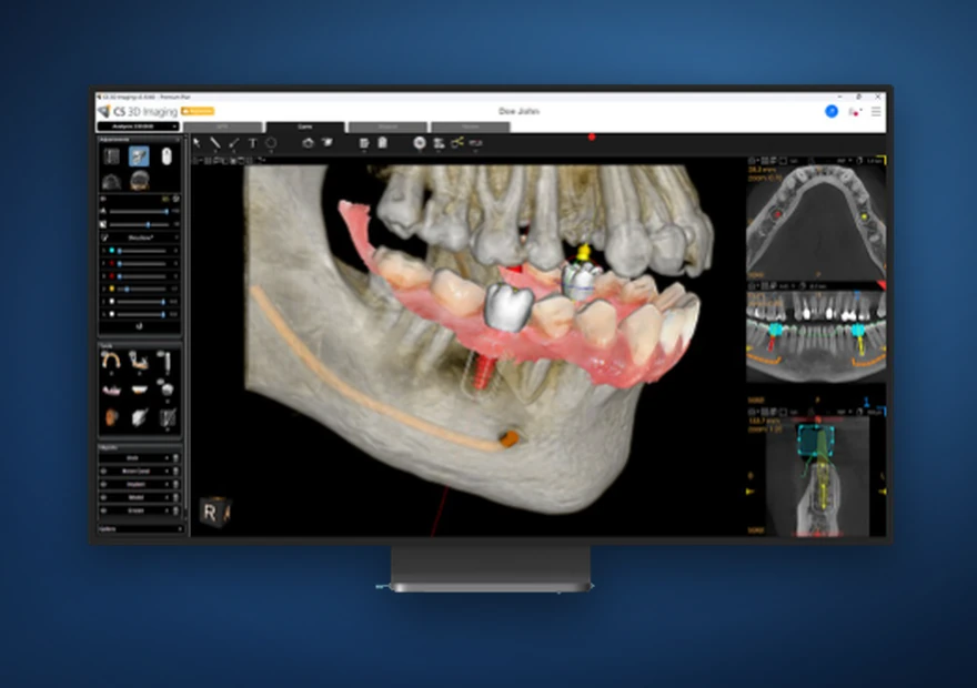 Software de planeamento digital com imagem dentária CBCT 3D reconstruída