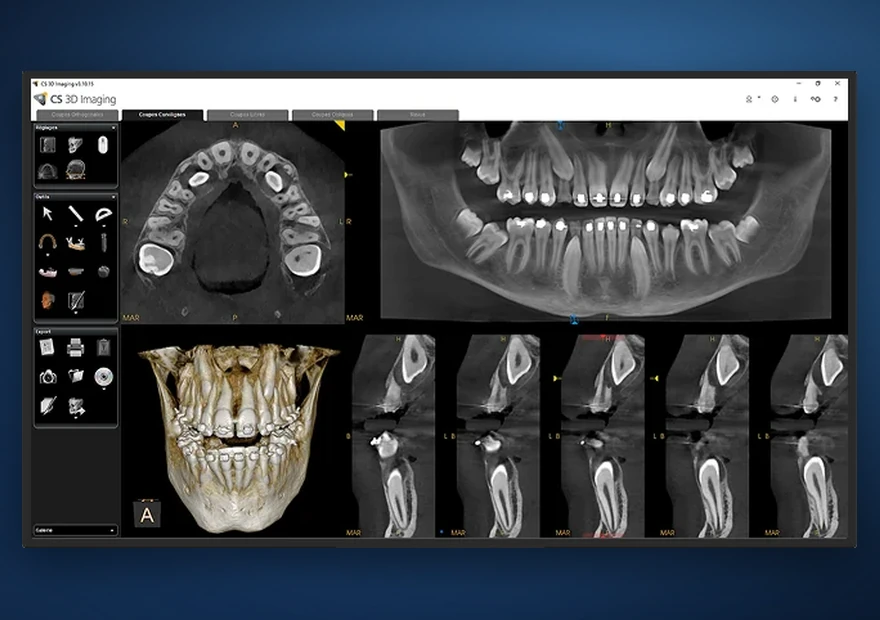 Reconstrução 3D de imagem dentária a partir de CBCT